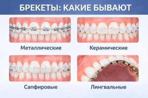 Брекеты: какие бывают и сколько носят?